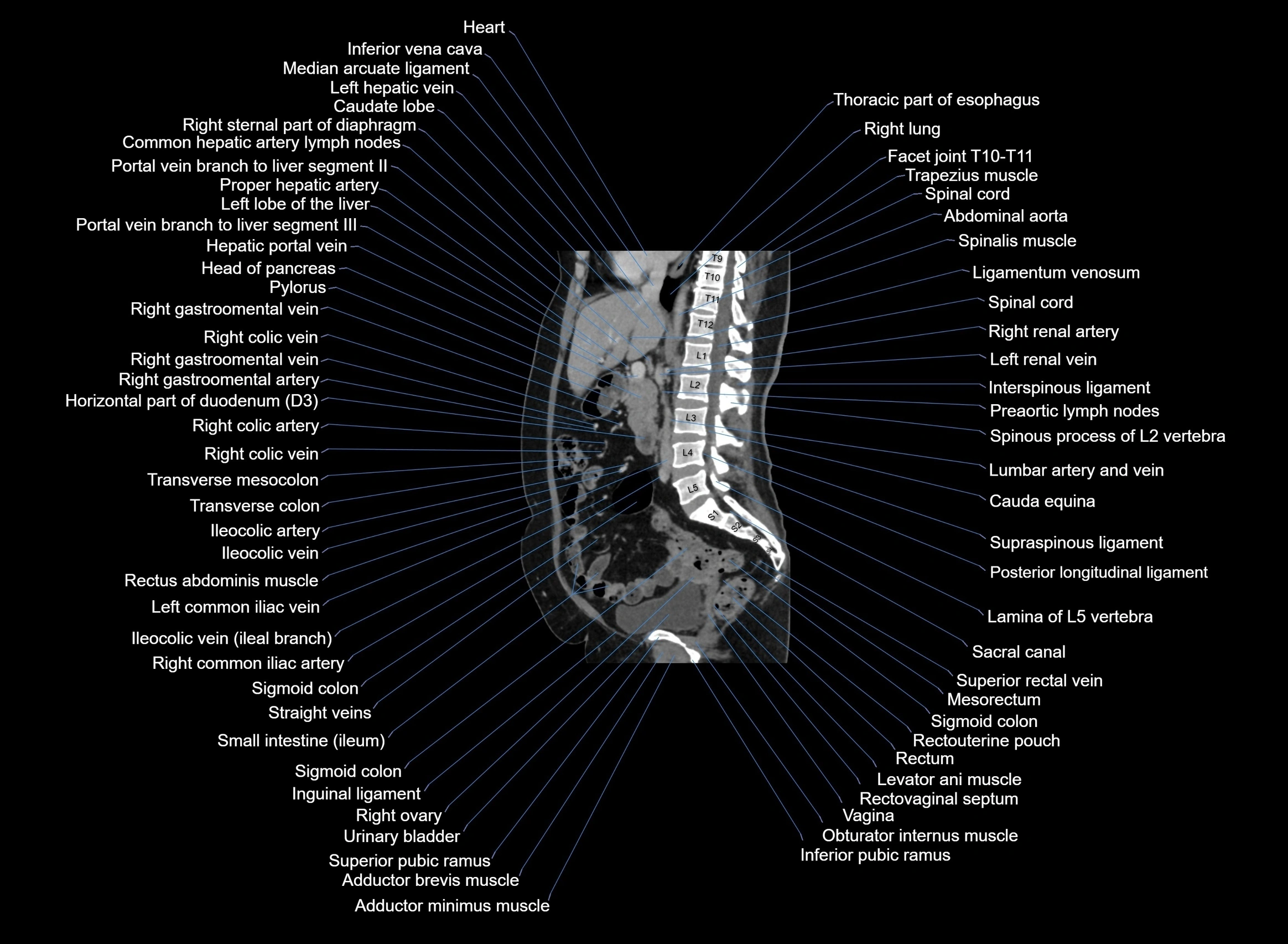 CT Abdomen sagittal cross sectional anatomy labelled radiology image -00063.webp